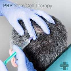 imagen de PRP  Therapy for Hair Loss_1