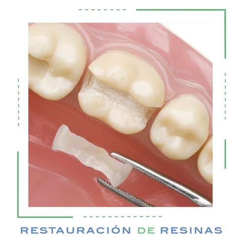 imagen de Restauraciones _1