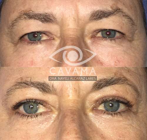 imagen de CIRUGIA DE PARPADOS_1