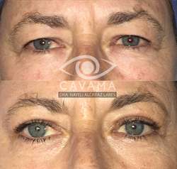 imagen de CIRUGIA DE PARPADOS_1