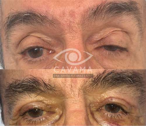 imagen de CAIDA DE PARPADOS_1