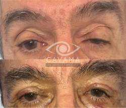 imagen de CAIDA DE PARPADOS_1