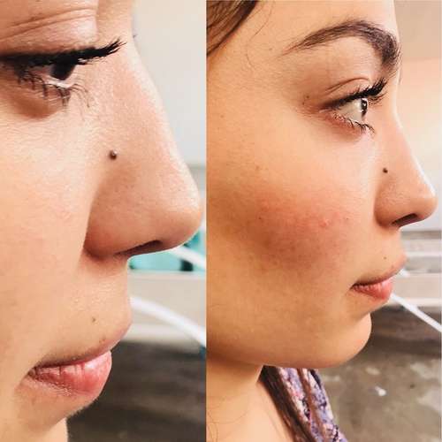 imagen de Rinomodelacion sin cirugia_1