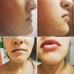 imagen de Aumento de labios con Acido Hialuronico_1
