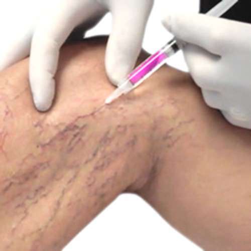 imagen de Eliminaccion de Varices_1