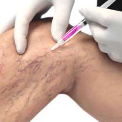 imagen de Eliminaccion de Varices_1