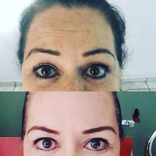 imagen de Aplicacion de Botox_1