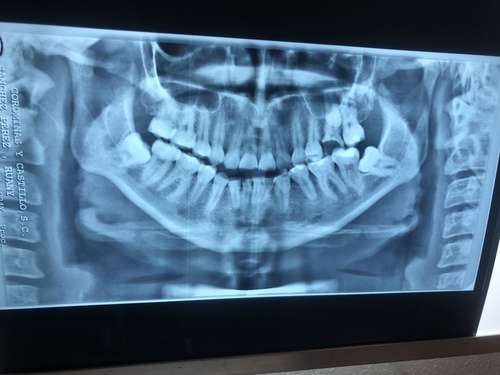 imagen de Cirugia de terceros molares _1