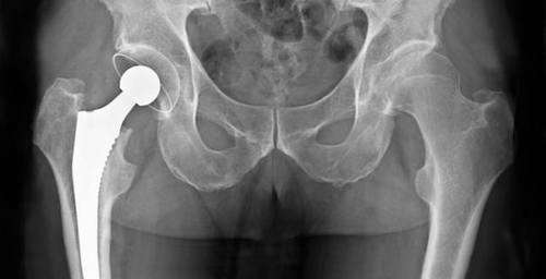 imagen de Protesis Total de Cadera_1