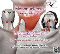 imagen de MONONUCLEOSIS_1