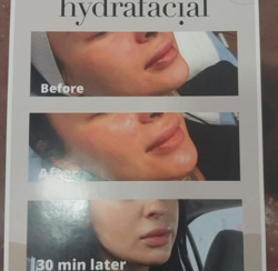 imagen de Hidrafacial_1