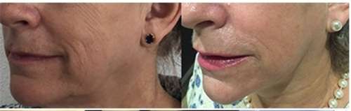 imagen de Láser co2 fraccionado_1