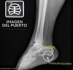 imagen de Radiografías de espolones_1