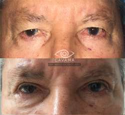 imagen de CIRUGIA DE PARPADOS_2