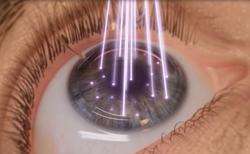 imagen de CIRUGIA LASER REFRACTIVA_2