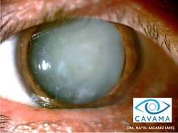 imagen de CIRUGIA DE CATARATA_2