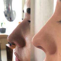 imagen de Rinomodelacion sin cirugia_2