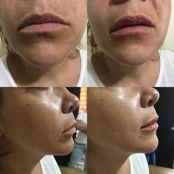 imagen de Aumento de labios con Acido Hialuronico_2