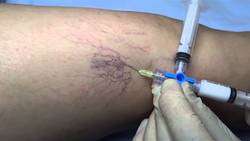 imagen de Eliminaccion de Varices_2