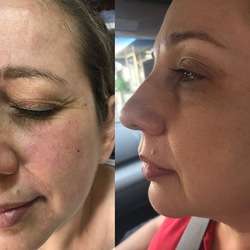 imagen de Aplicacion de Botox_2