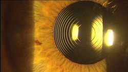 imagen de CIRUGIA DE CATARATA_3