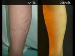 imagen de Eliminaccion de Varices_3